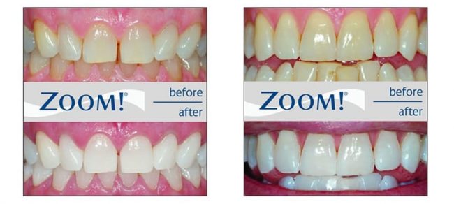 ZOOM-Before-After1