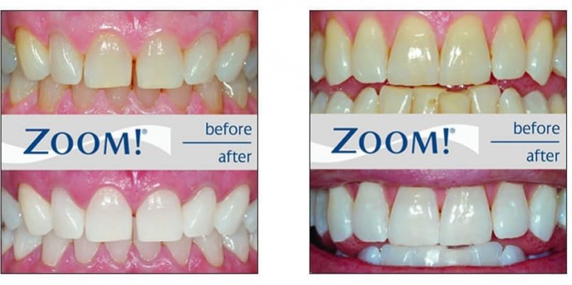 ZOOM-Before-After1